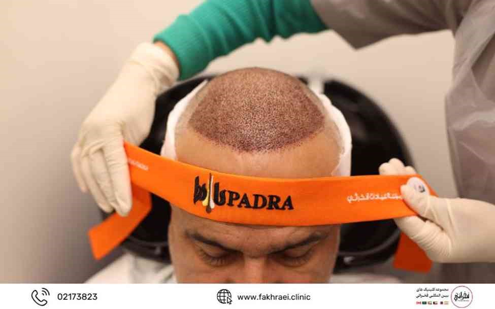به روز ترین روش های کاشت مو در کلینیک کاشت مو فخرائی