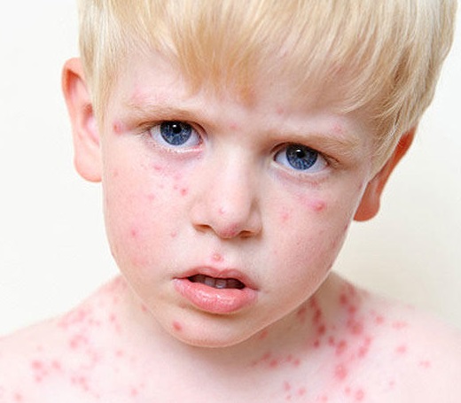 سندروم ری علائم و درمان + علت و تشخیص نشانگان ری