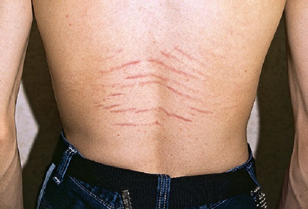 اسید گلیکولیک برای رفع ترک های پوستی