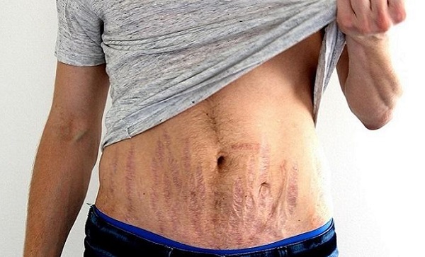 ترک های پوستی در ناحیه شکم