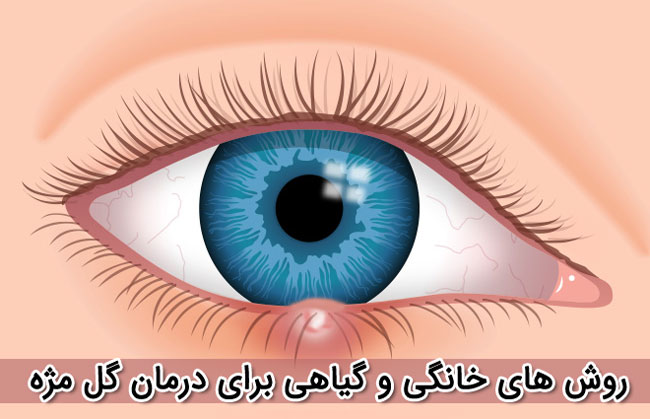 درمان گل مژه با 17 روش گیاهی و خانگی - دلایل گل مژه