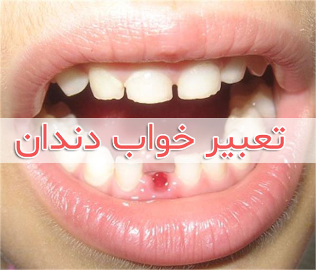 تعبیر خواب دندان چیست ؟ دیدن افتادن دندان ها در خواب چه معنی دارد ؟