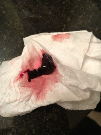 عکس موکوس قبل از زایمان