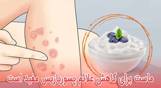 ماست برای کاهش علائم پسوریازیس مفید است