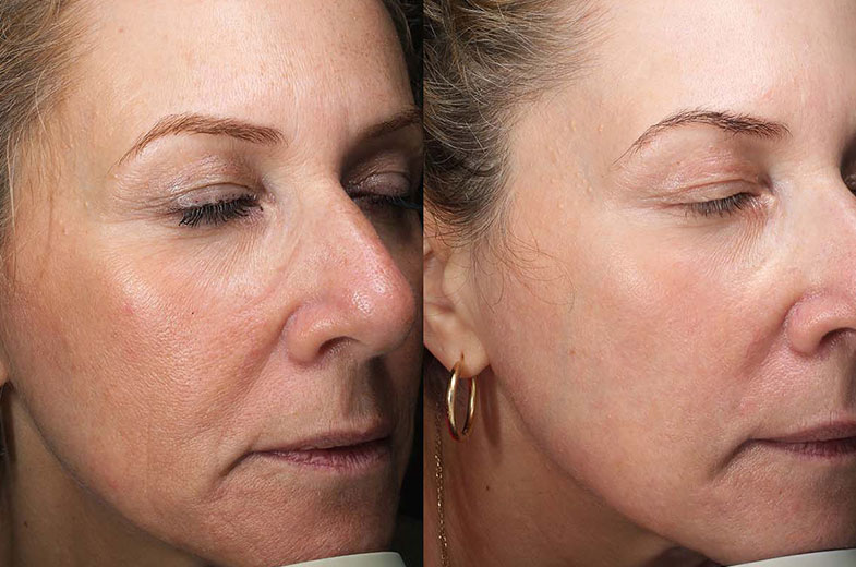 تأثیر لیزر CO2 بر رفع چین&zwnj;وچروک و خطوط ریز پوست با بهبود بافت و سفتی پوست